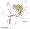 Des hormones, 20, UNE FEMME A PROSTATE…