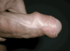 Foreskin Gif Chez Maitre Dolyve