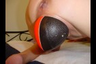dilatation