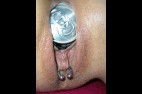 dilatation