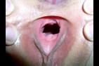 dilatation