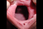 dilatation