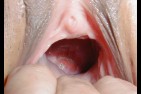 dilatation