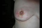 marques-seins.jpg