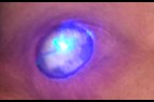 Oeil de cyclope