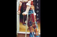 braces-1.jpg