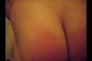 les fesses apres les 40 coups