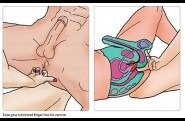 stimulation prostate etape 3 (2)
