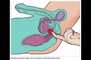 stimulation prostate etape 5jpg
