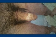 epilation (1)