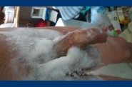 epilation (2)