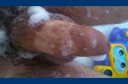 epilation (3)