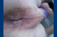 fesse 0432