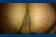 fesse 0461