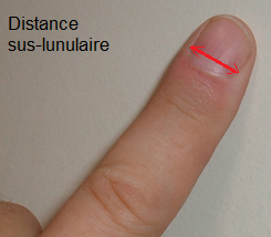 distance_sus_lunulaire.png