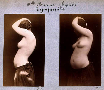 Albert-Londe-Mlle-Banares--hysterie-.1883.jpg