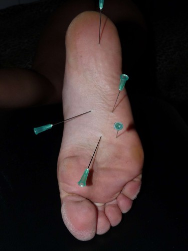 amateur-needle-pain-12.jpg