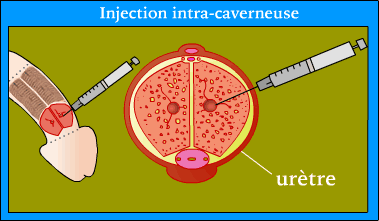 INJECTION1