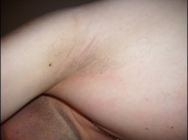 dessous de bras apres rasage