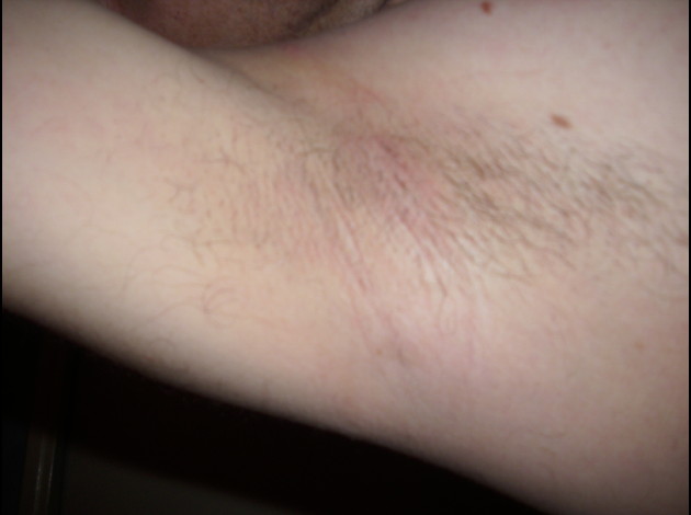 dessous de bras apres rasage 2