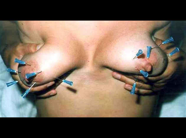 Aiguilles dans les seins (149)