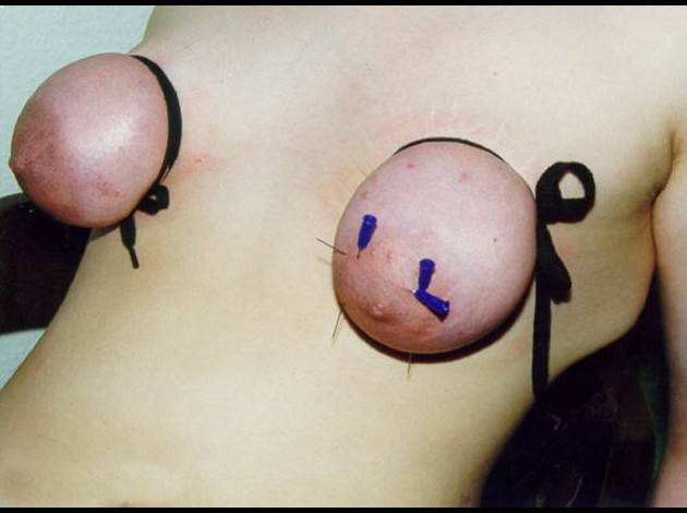 Aiguilles dans les seins (49)