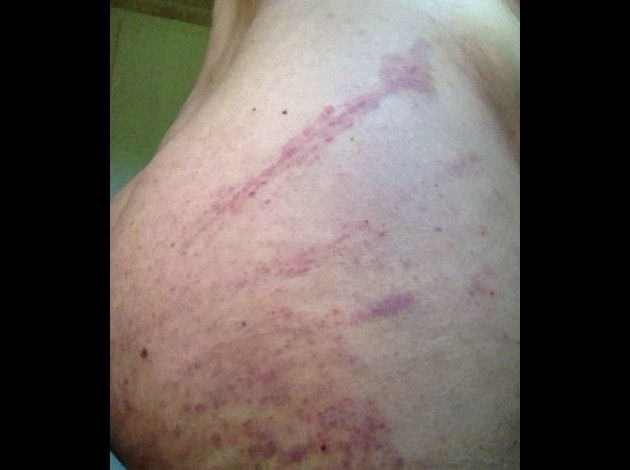 photo fesse droite 2