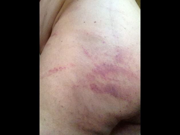 photo fesse gauche 2