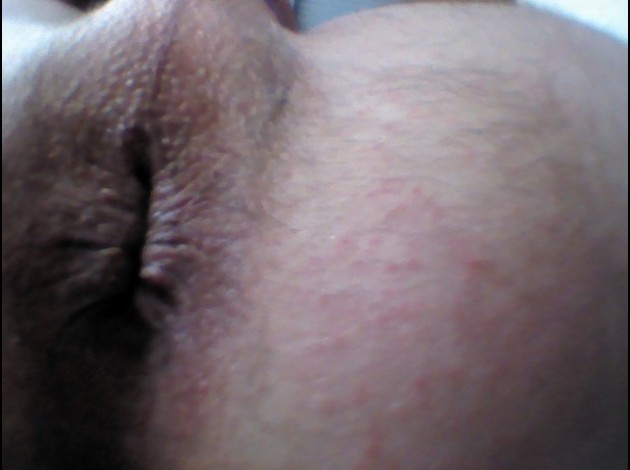 fesse 0431