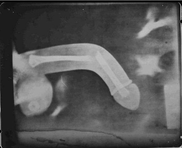 fracture.jpg