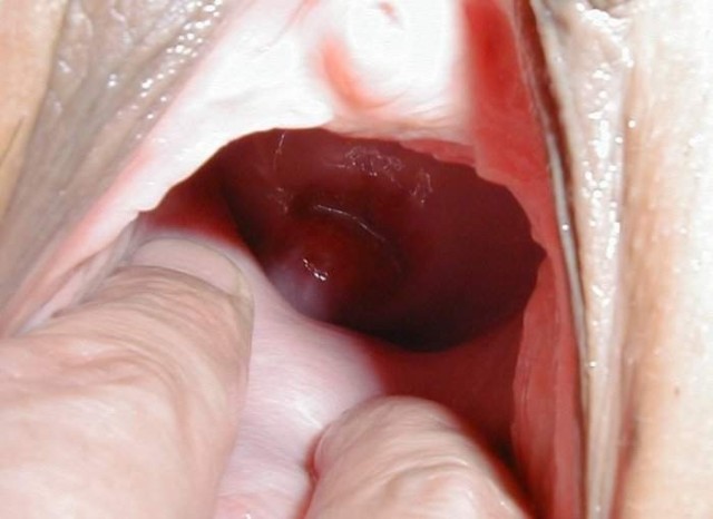 dilatationvaginal016.jpg