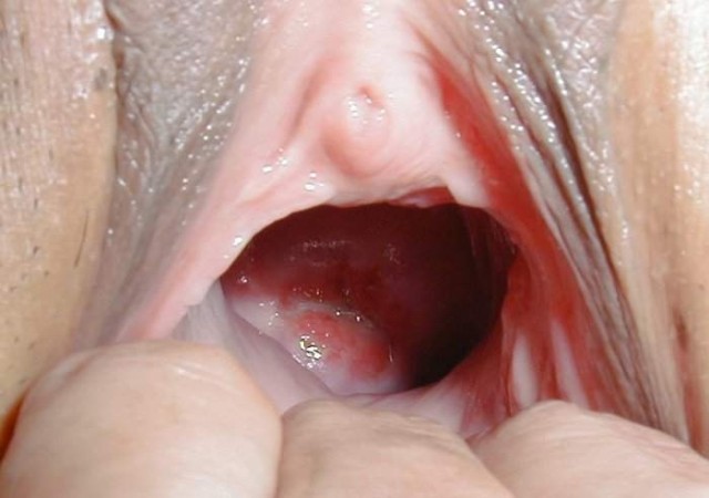dilatationvaginal017.jpg