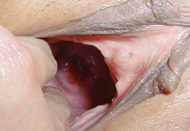 dilatationvaginal020.jpg