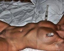 seringue---ventouse-sur-les-seins.jpg