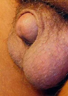 micropenis.jpg