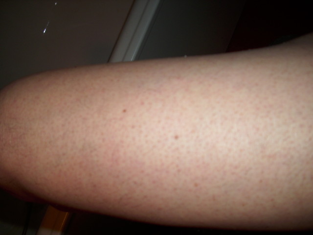 cuisse apres rasage