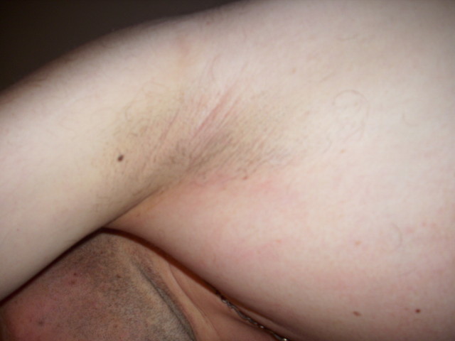 dessous de bras apres rasage