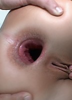Anus dilaté