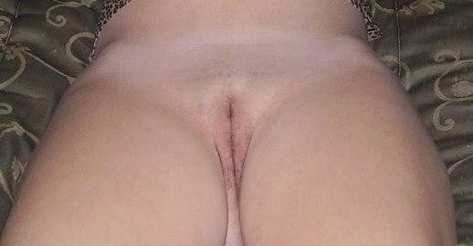 melanosis2