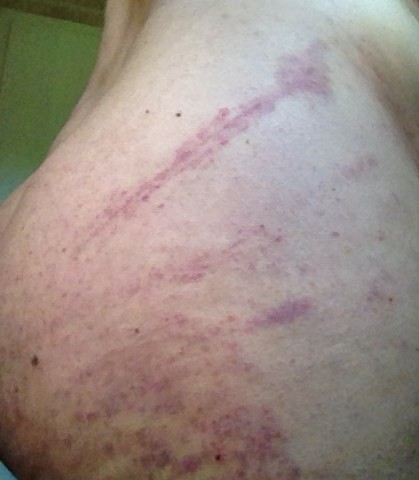 photo fesse droite 2