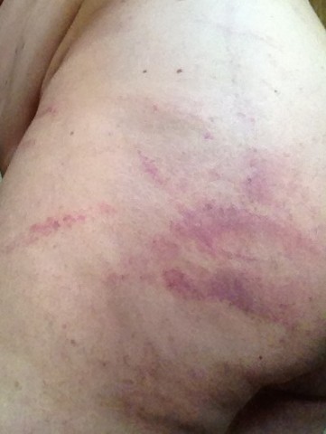 photo fesse gauche 2