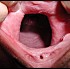 dilatation